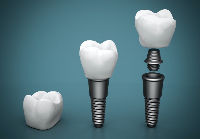 dental implant crown with abutment and implant post